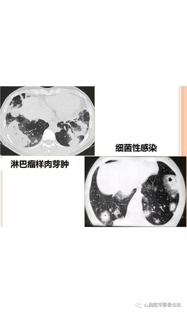 【病例】肺淋巴瘤样肉芽肿LYG一例CT影像诊断与鉴别