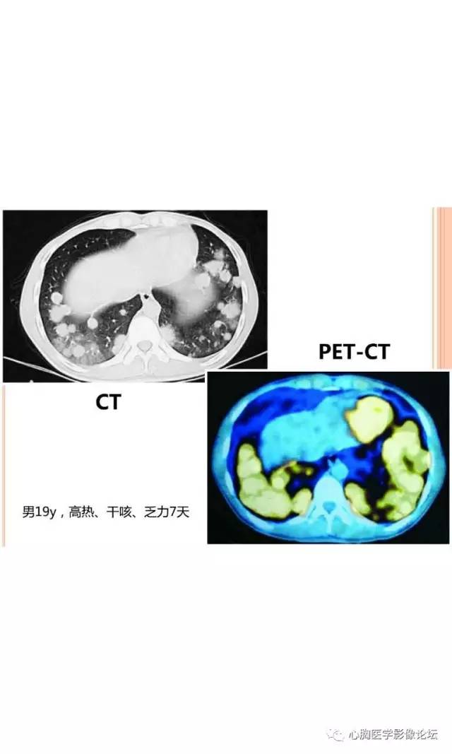 【病例】肺淋巴瘤样肉芽肿LYG一例CT影像诊断与鉴别