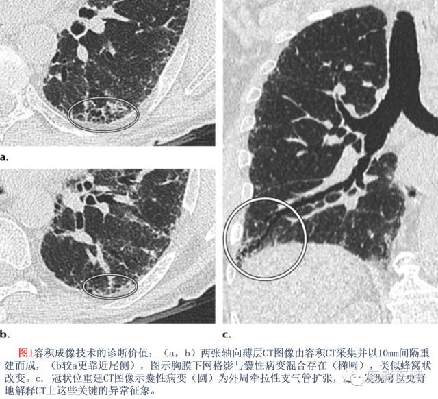 特发性间质性肺炎的分类：自2002年以来知识新进展