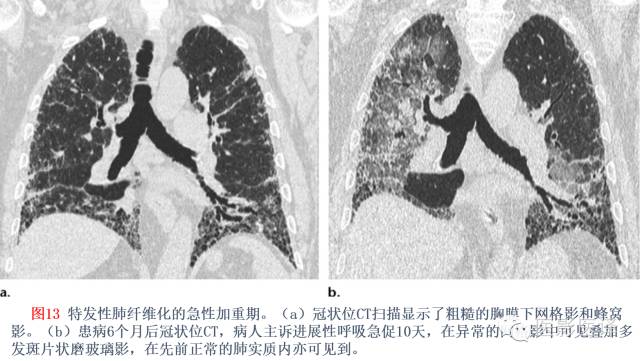特发性间质性肺炎的分类：自2002年以来知识新进展
