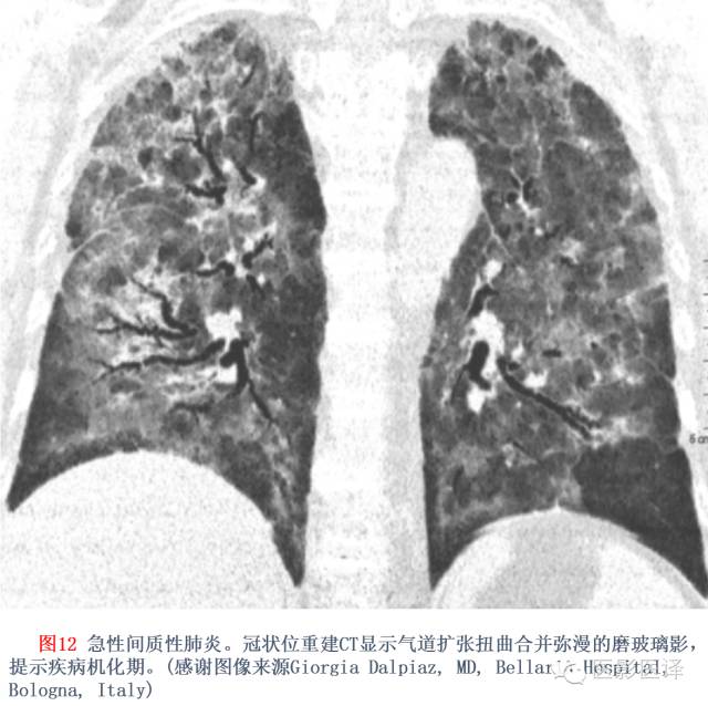 特发性间质性肺炎的分类：自2002年以来知识新进展