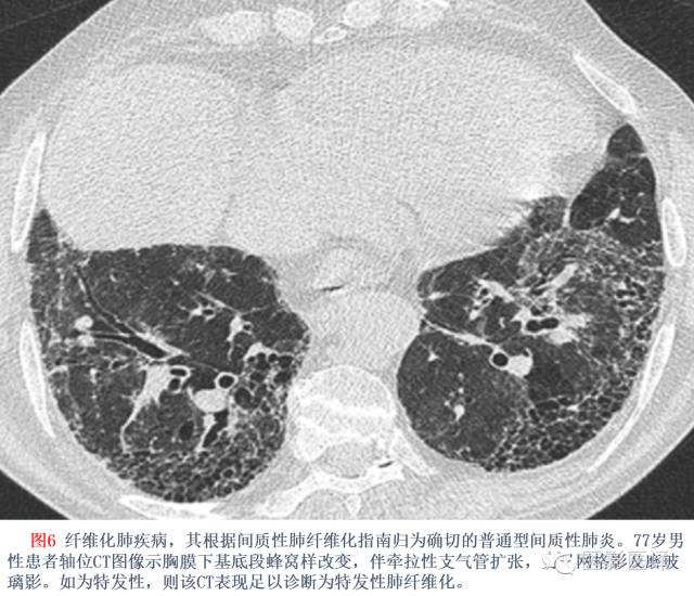 特发性间质性肺炎的分类：自2002年以来知识新进展