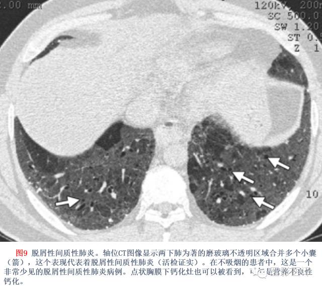 特发性间质性肺炎的分类：自2002年以来知识新进展