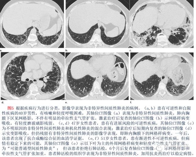 特发性间质性肺炎的分类：自2002年以来知识新进展