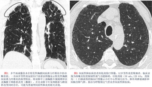 特发性间质性肺炎的分类：自2002年以来知识新进展