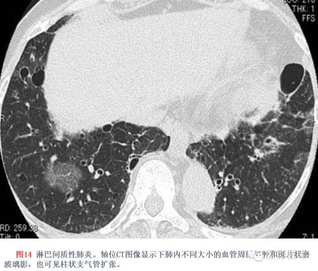 特发性间质性肺炎的分类：自2002年以来知识新进展