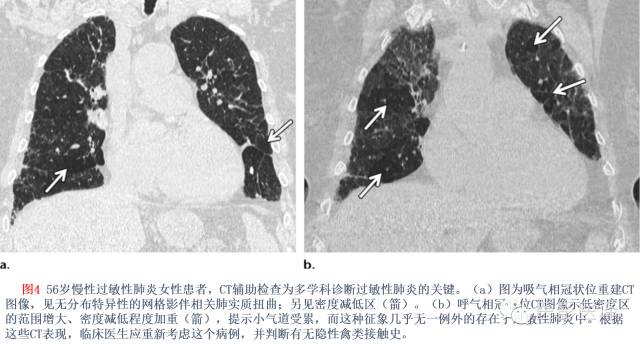 特发性间质性肺炎的分类：自2002年以来知识新进展