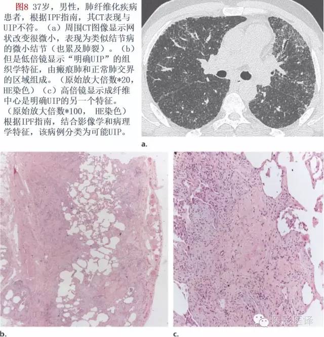 特发性间质性肺炎的分类：自2002年以来知识新进展