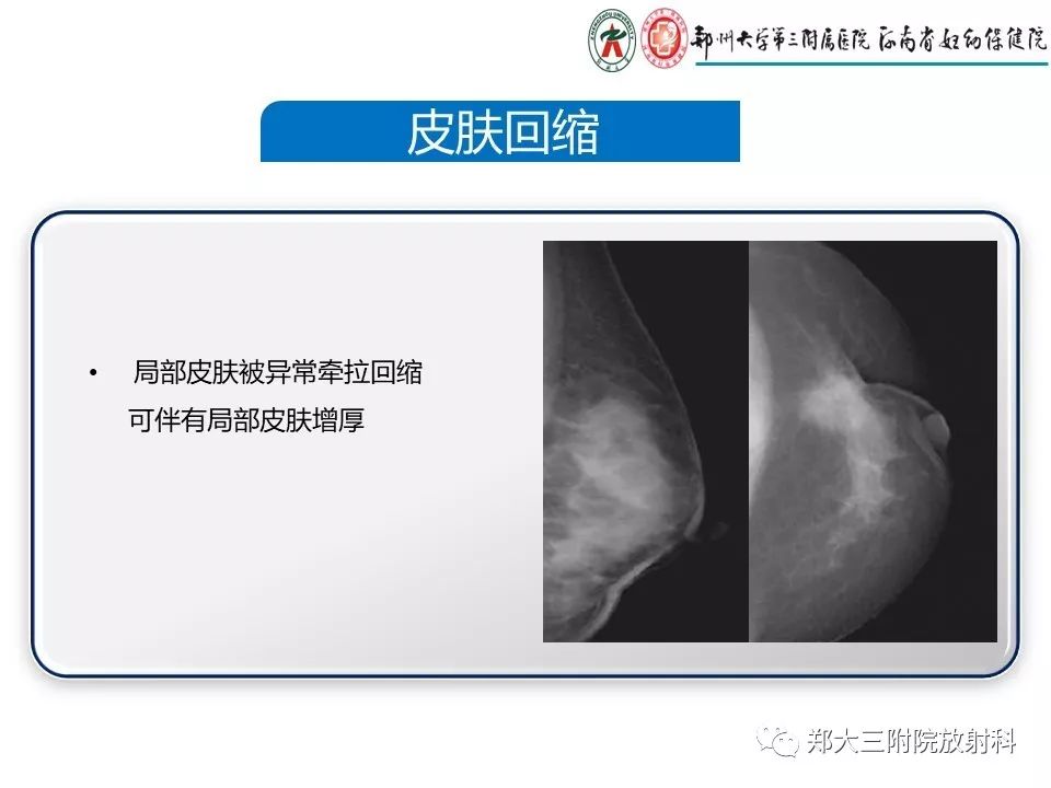 【PPT】乳腺X线特殊征象与合并征象 【PPT】乳腺X线特殊征象与合并征象