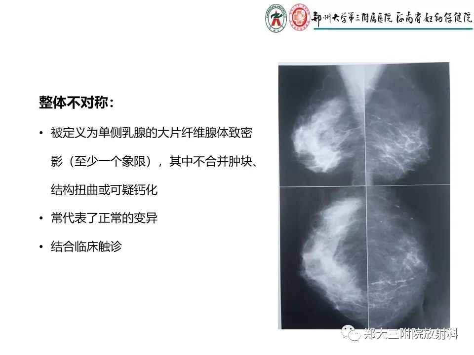 【PPT】乳腺X线特殊征象与合并征象 【PPT】乳腺X线特殊征象与合并征象
