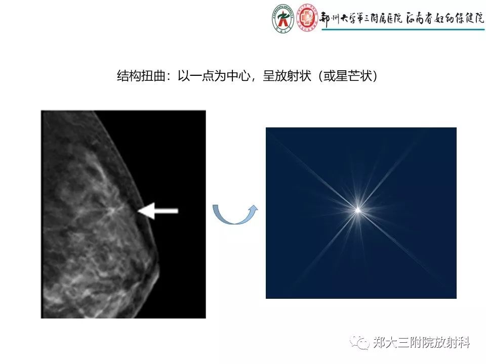 【PPT】乳腺X线特殊征象与合并征象