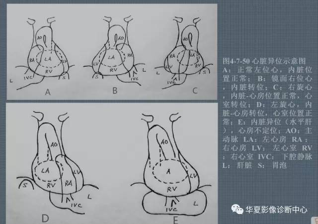 左旋心、右旋心、中位心、镜面右位心，你都弄清楚了？