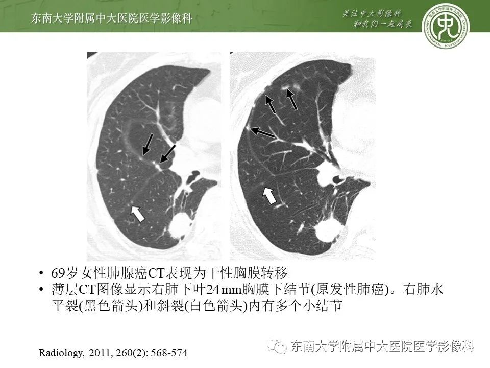【PPT】干性胸膜转移