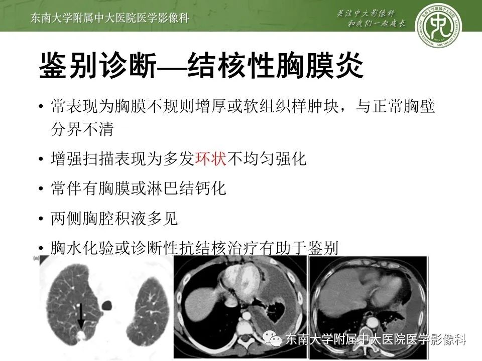 【PPT】干性胸膜转移