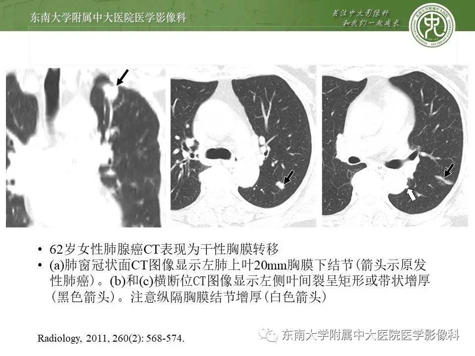 【PPT】干性胸膜转移