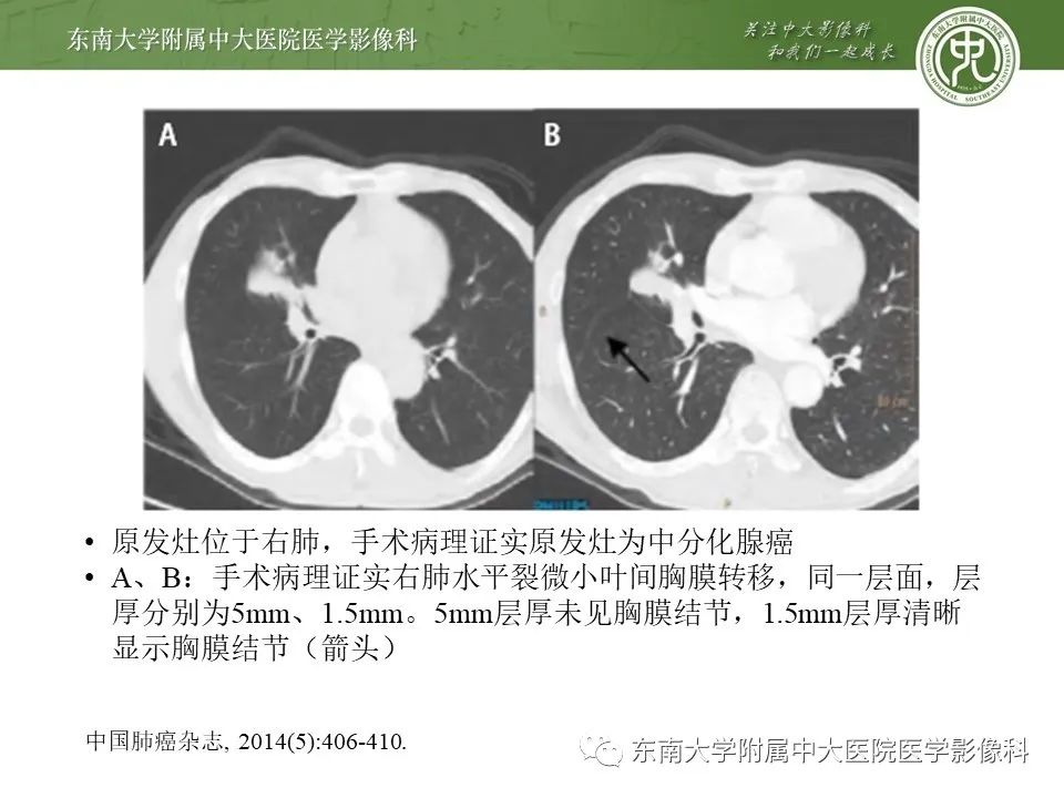 【PPT】干性胸膜转移
