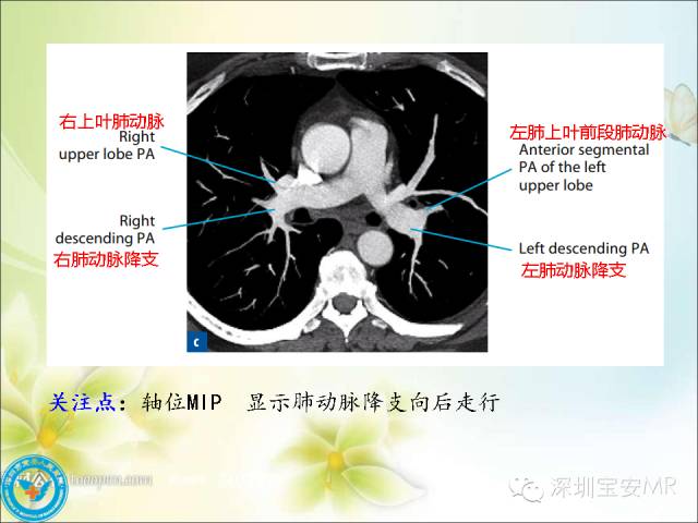 【PPT】肺动、静脉影像断层解剖图解