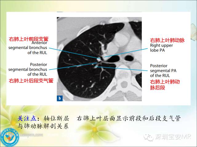 【PPT】肺动、静脉影像断层解剖图解