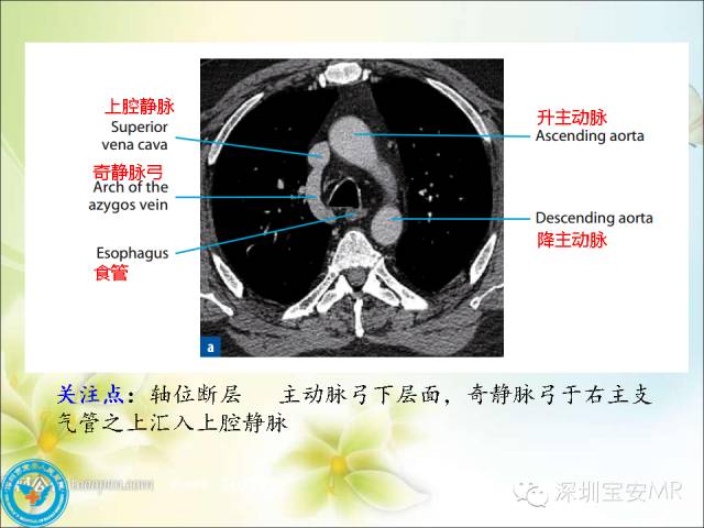 【PPT】肺动、静脉影像断层解剖图解