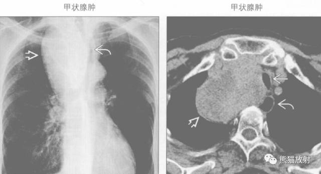 “纵隔囊性肿块”的鉴别诊断