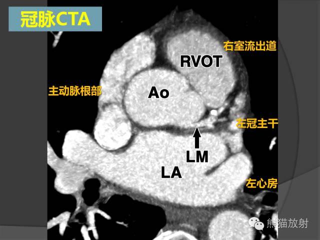 【PPT】冠状动脉解剖