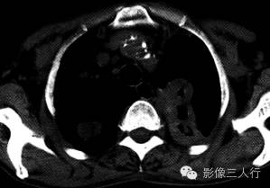 【病例】继发性肺结核1例CT影像表现分析