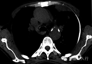 【病例】继发性肺结核1例CT影像表现分析 【病例】继发性肺结核1例CT影像表现分析
