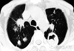 【病例】继发性肺结核1例CT影像表现分析 【病例】继发性肺结核1例CT影像表现分析