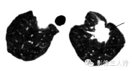 良恶性肺结节的鉴别诊断