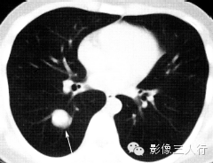 良恶性肺结节的鉴别诊断