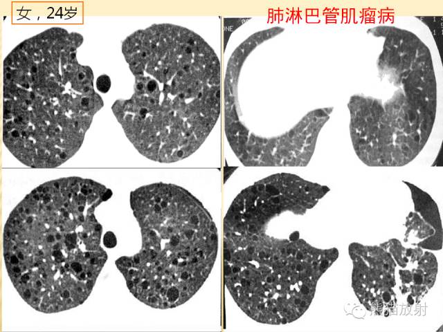 【PPT】间质性肺疾病的鉴别诊断