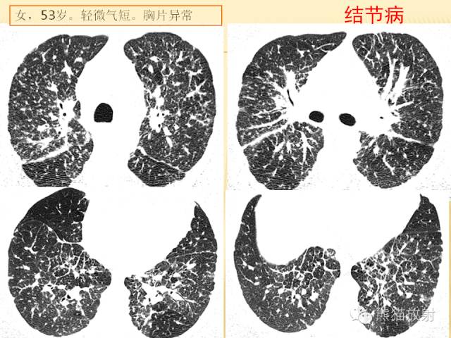 【PPT】间质性肺疾病的鉴别诊断