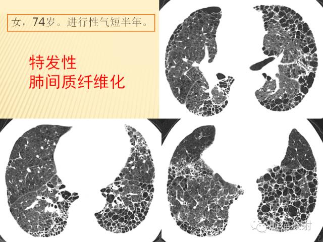 【PPT】间质性肺疾病的鉴别诊断