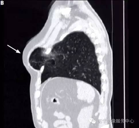 【病例】肺疝的CT图像，你见过吗？