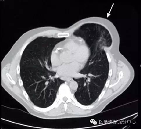 【病例】肺疝的CT图像，你见过吗？