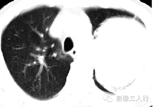【病例】肺癌肉瘤1例X线CT影像表现