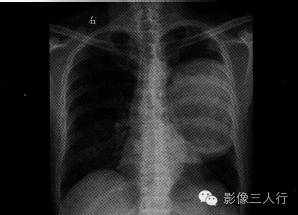 【病例】肺癌肉瘤1例X线CT影像表现