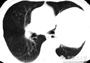 【病例】肺癌肉瘤1例X线CT影像表现