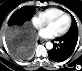 【病例】右膈肌平滑肌肉瘤黏液变性1例CT影像表现 【病例】右膈肌平滑肌肉瘤黏液变性1例CT影像表现