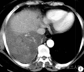 【病例】右膈肌平滑肌肉瘤黏液变性1例CT影像表现 【病例】右膈肌平滑肌肉瘤黏液变性1例CT影像表现
