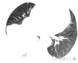 【病例】右膈肌平滑肌肉瘤黏液变性1例CT影像表现
