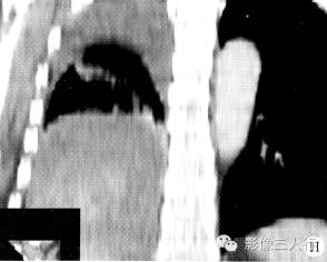 【病例】右膈肌平滑肌肉瘤黏液变性1例CT影像表现 【病例】右膈肌平滑肌肉瘤黏液变性1例CT影像表现