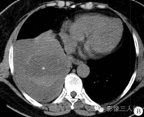 【病例】右膈肌平滑肌肉瘤黏液变性1例CT影像表现 【病例】右膈肌平滑肌肉瘤黏液变性1例CT影像表现