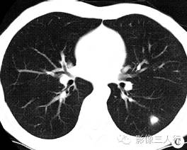 【病例】侵袭性肺曲菌病1例CT影像表现