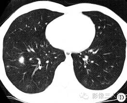 【病例】侵袭性肺曲菌病1例CT影像表现