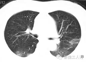 【病例】慢性嗜酸性细胞肺浸润1例CT影像表现分析