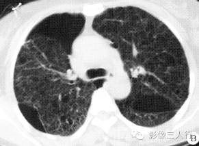 【病例】肺淋巴管平滑肌瘤病1例CT影像表现 【病例】肺淋巴管平滑肌瘤病1例CT影像表现