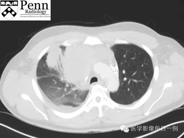 【病例】纵膈精原细胞瘤1例CT影像表现