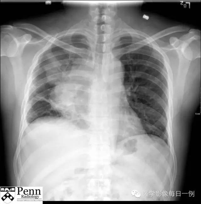 【病例】纵膈精原细胞瘤1例CT影像表现