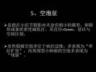 肺内孤立性小结节的CT诊断探析